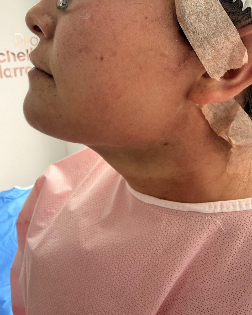 Lipopapada: contorno del cuello y la mandíbula, perfil, al terminar la sesión
