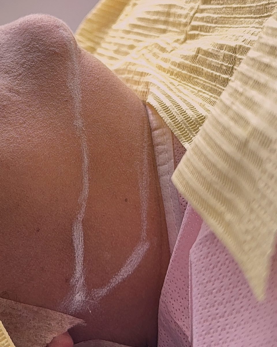 Lipopapada: contorno del cuello y la mandíbula, debajo del mentón, antes