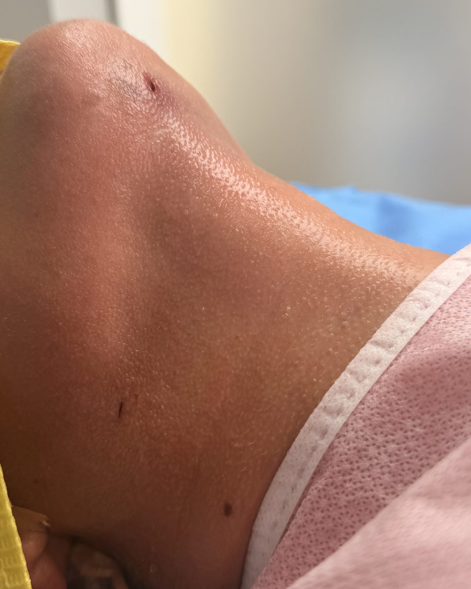 Lipopapada: contorno del cuello y la mandíbula, debajo del mentón, al terminar la sesión